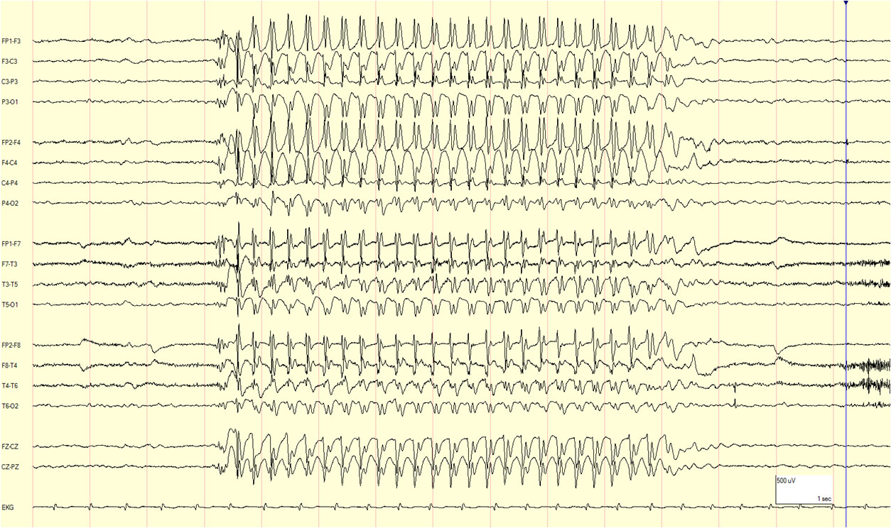 eeg