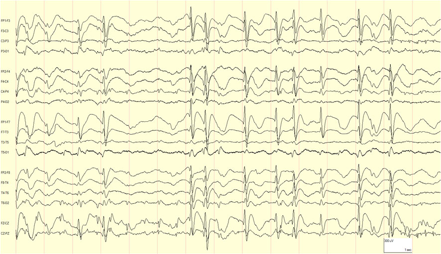 eeg