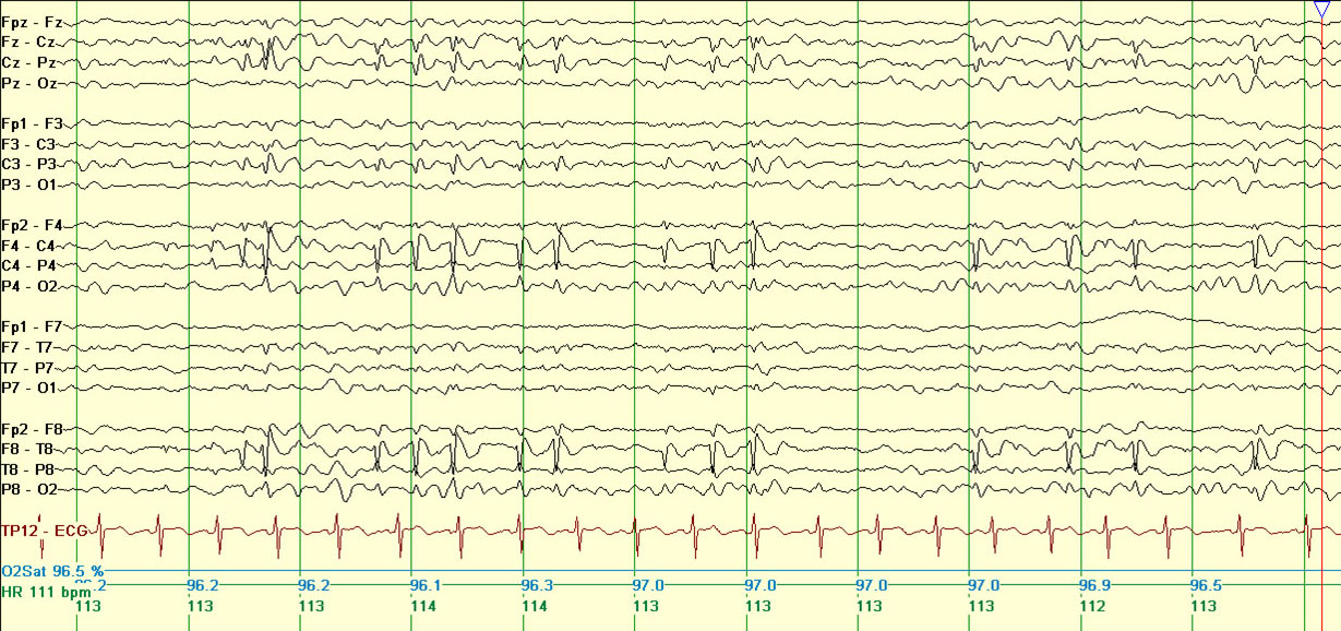 eeg