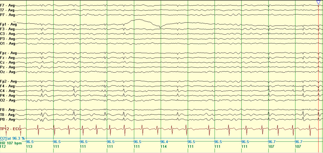 eeg