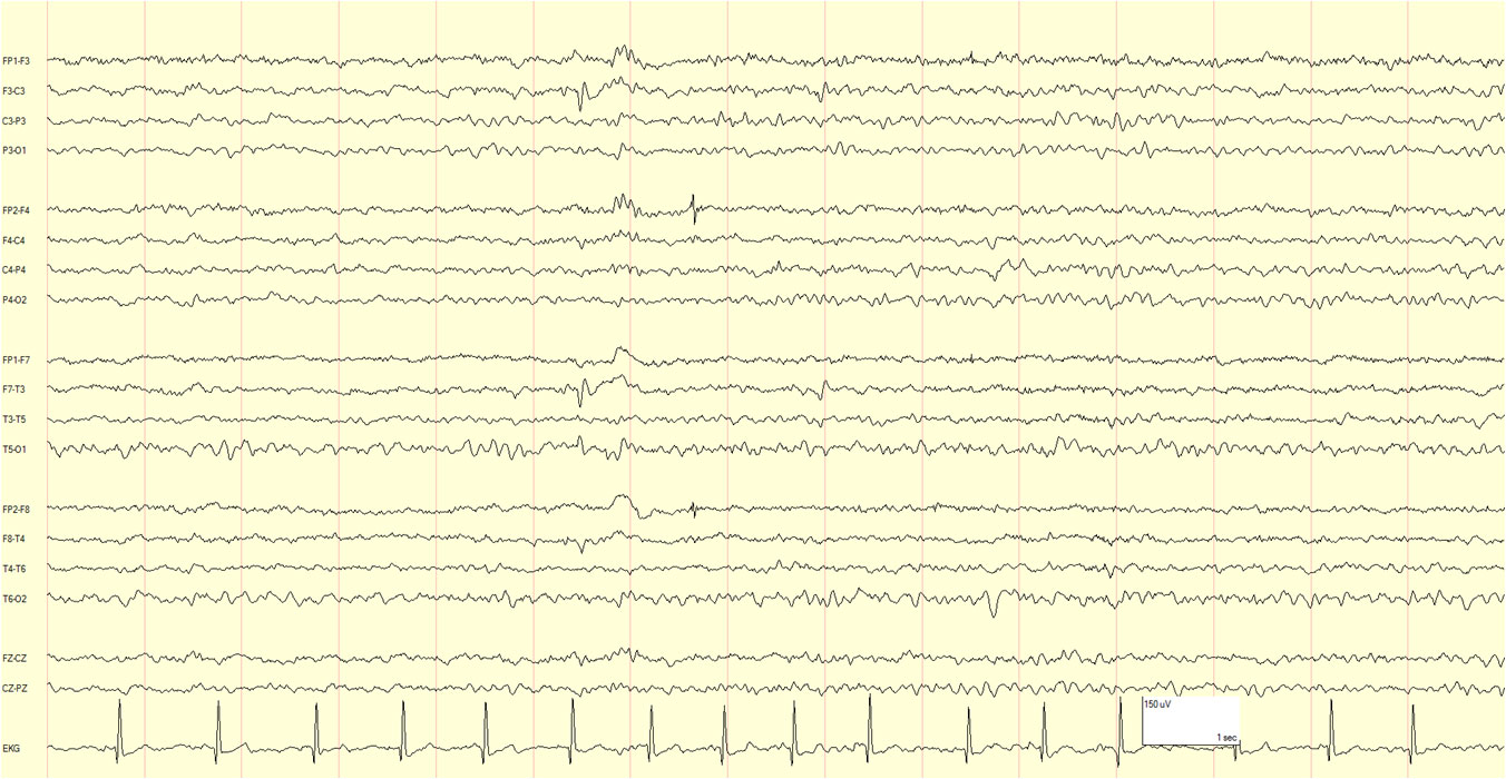 eeg