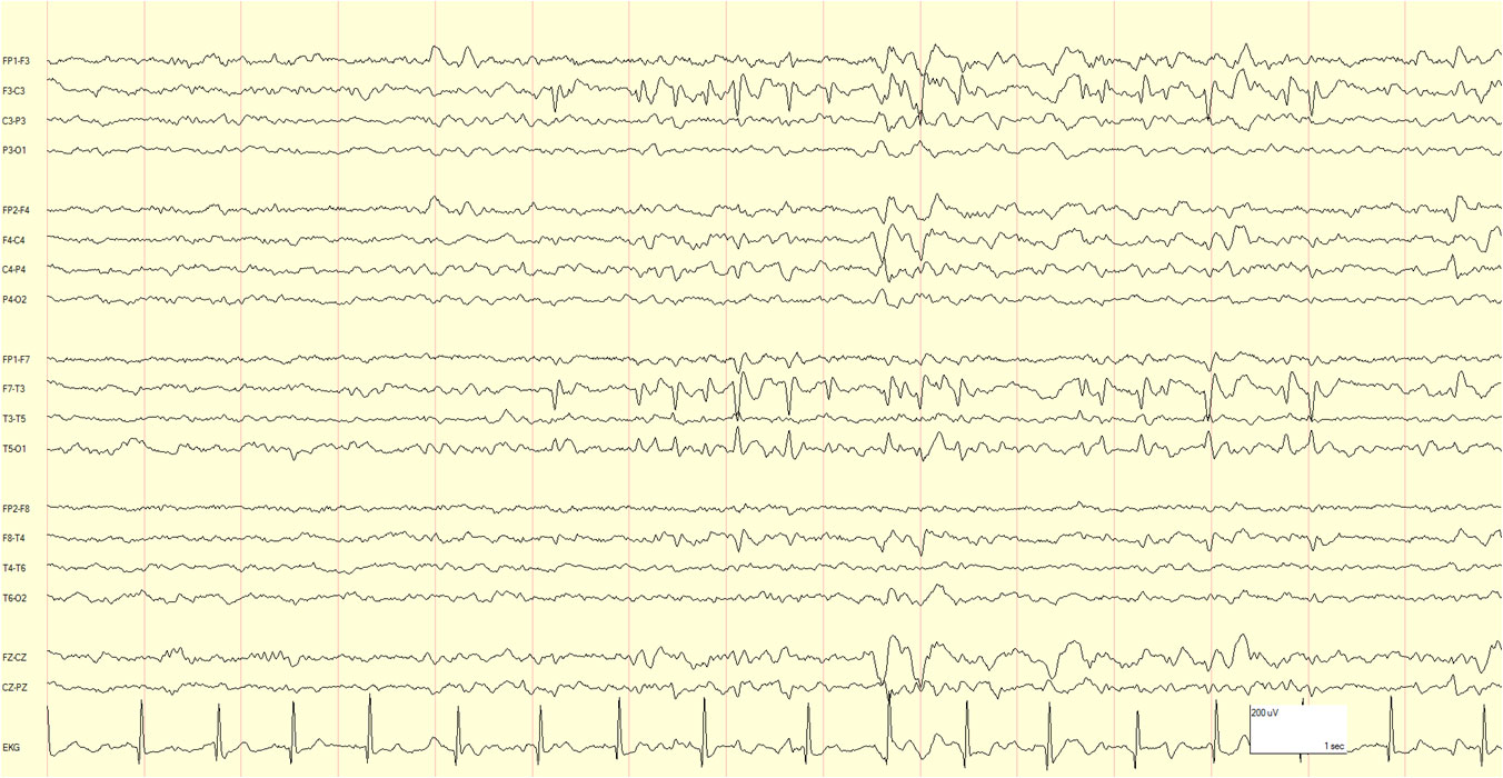 eeg