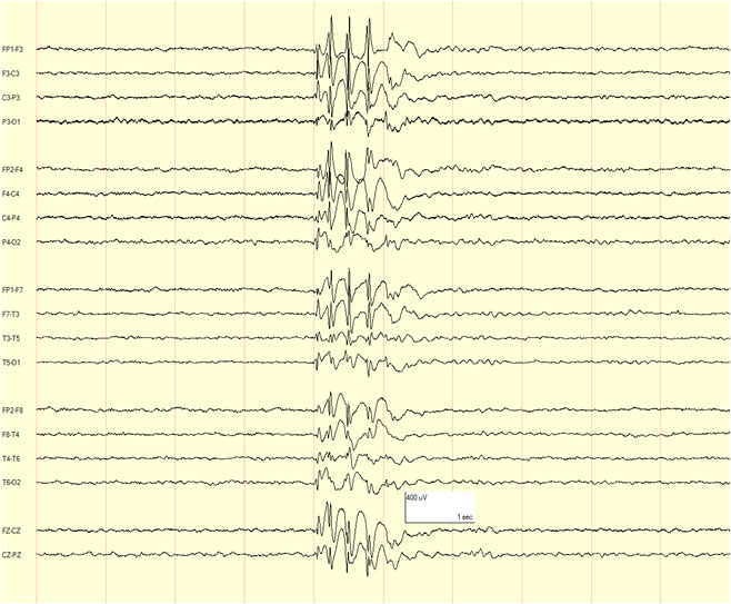 eeg