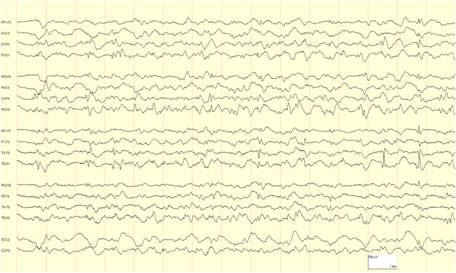 eeg