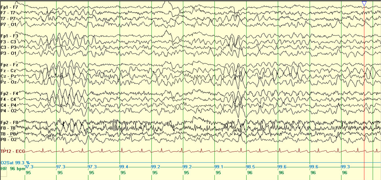 eeg