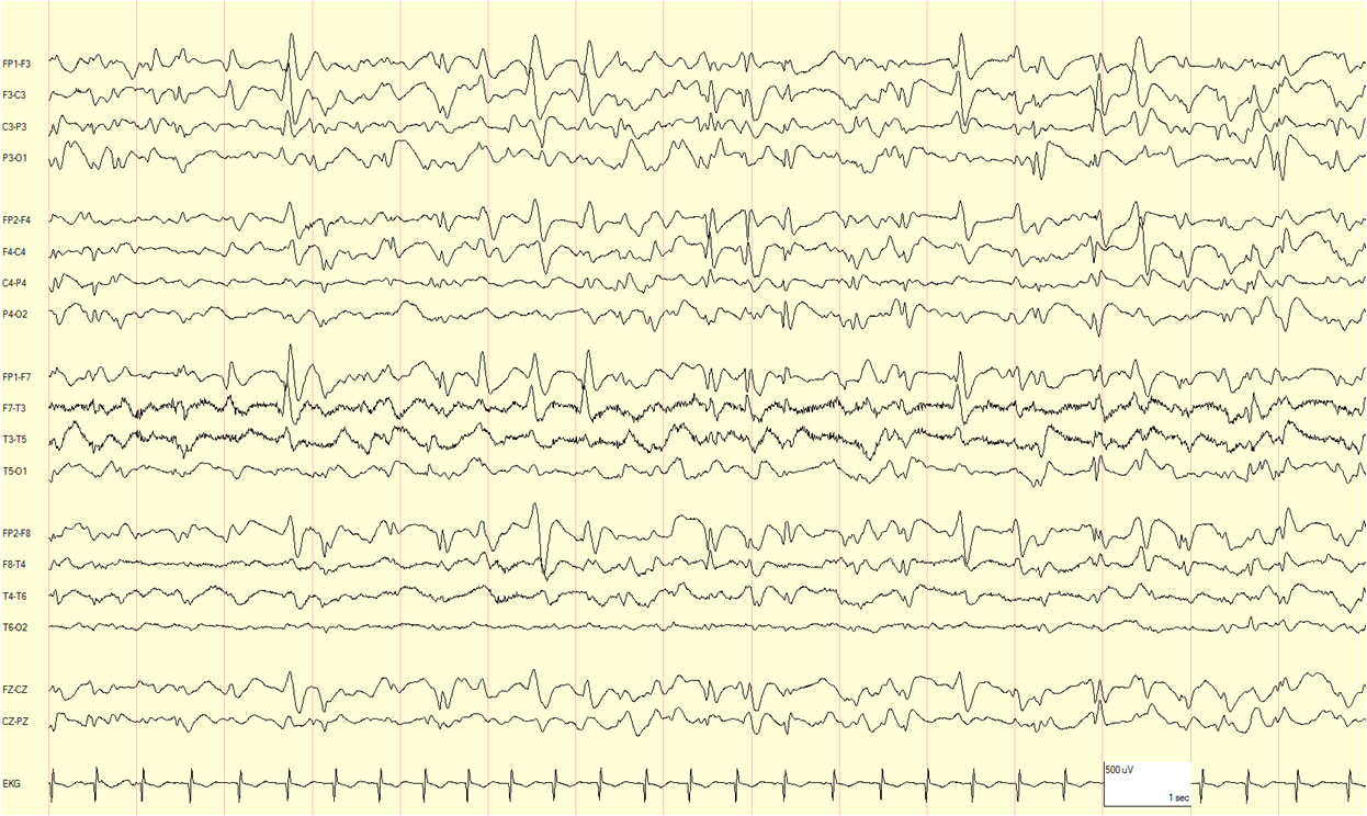 eeg