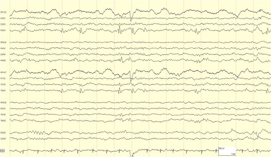 eeg