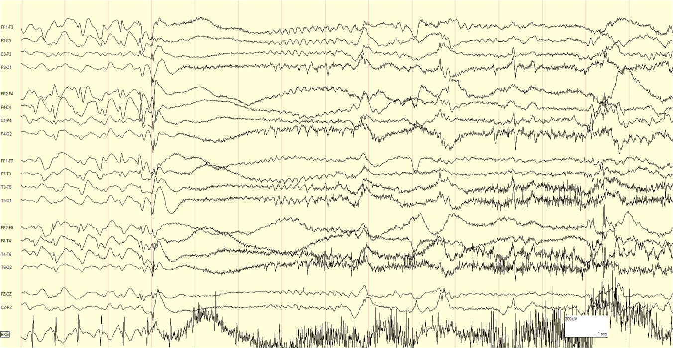 eeg