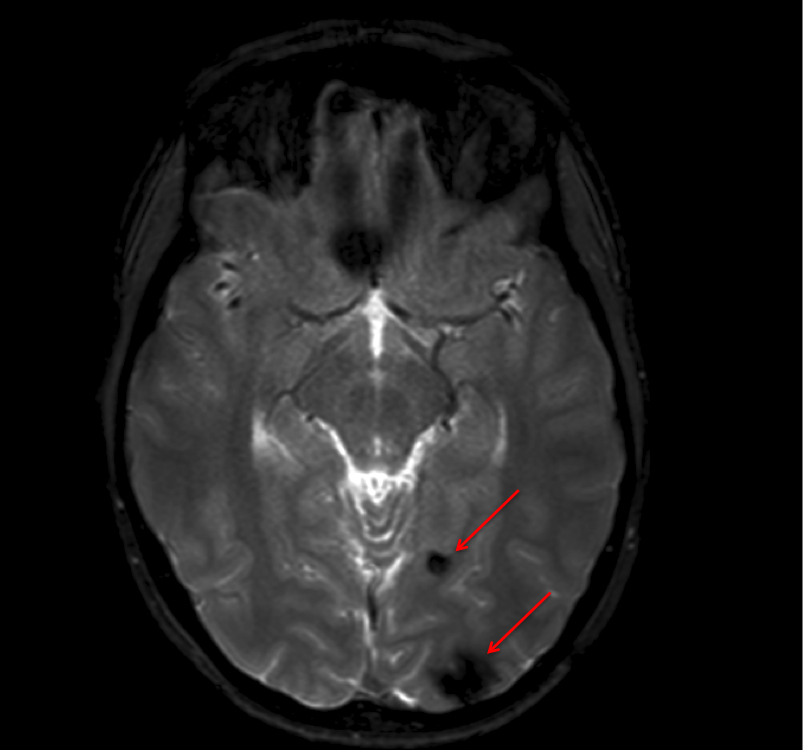 cerebral angioma 1