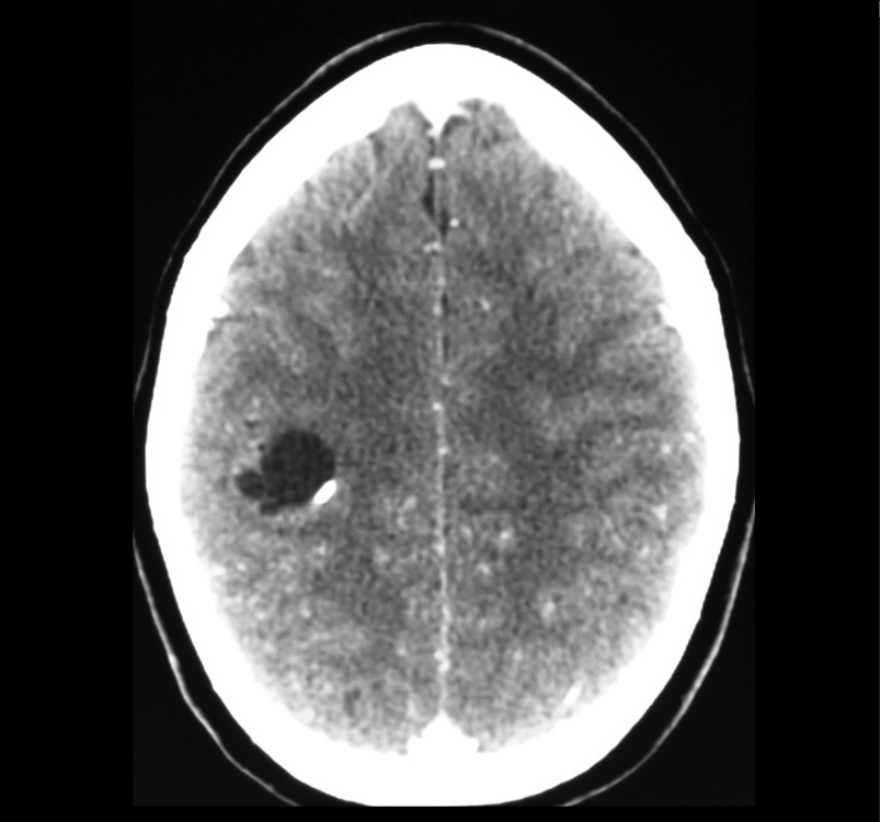 ganglioglioma 1