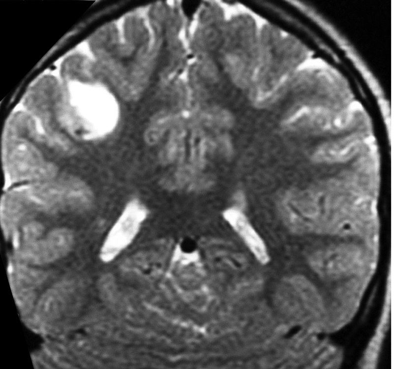 ganglioglioma 2