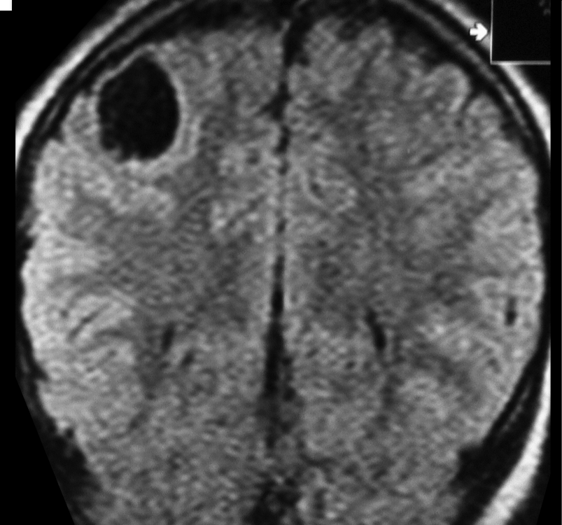 ganglioglioma 3