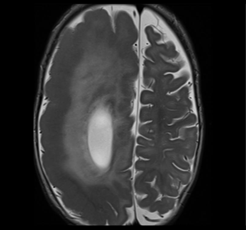 hemimegalencephaly