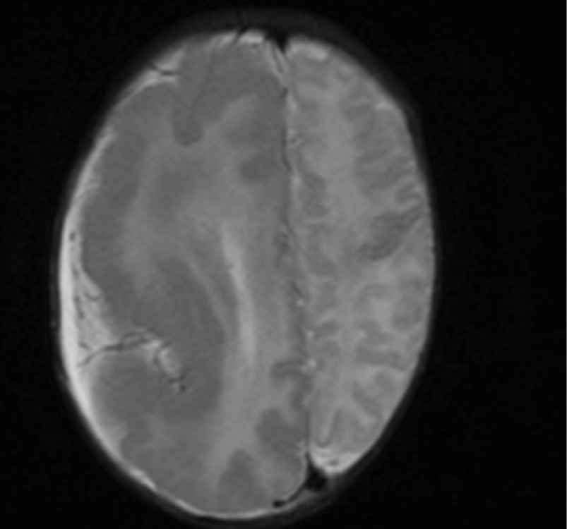 hemimegalencephaly