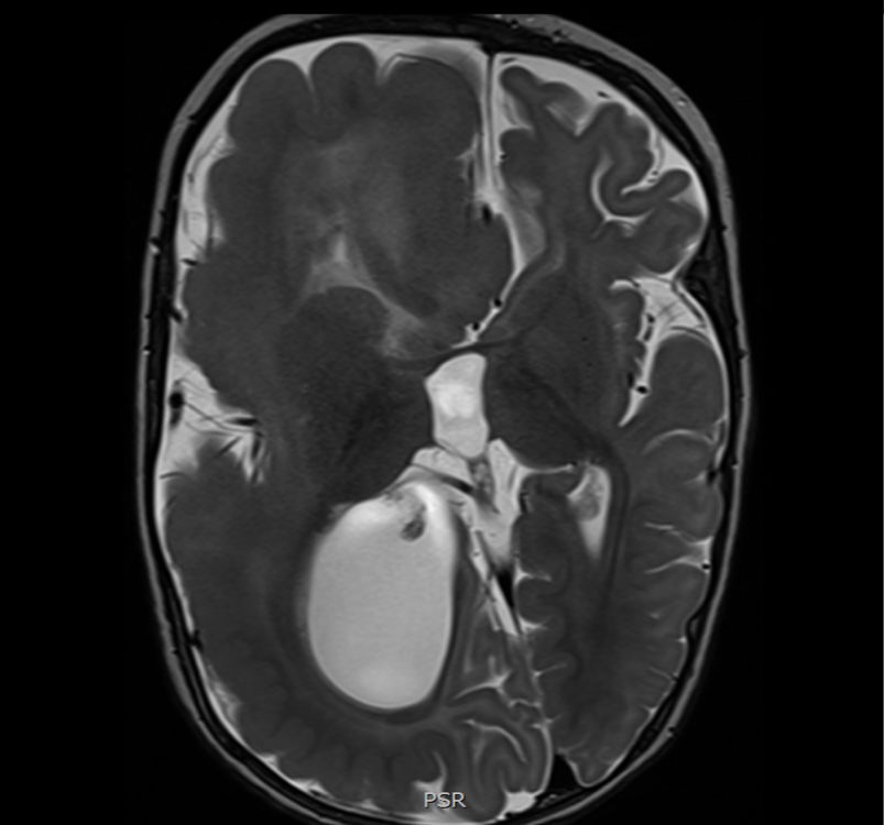 hemimegalencephaly