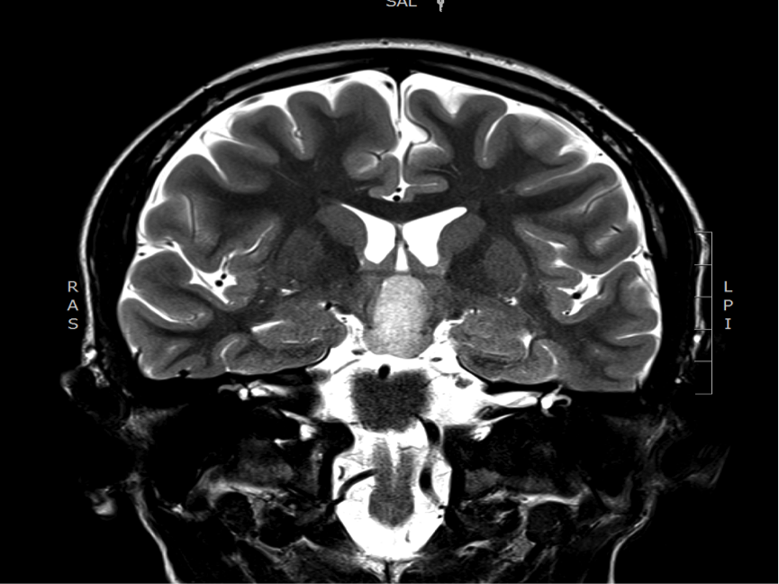 hypothalamic hamartoma 1