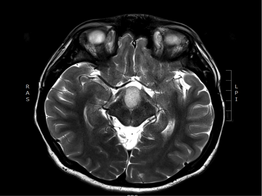 hypothalamic hamartoma 2