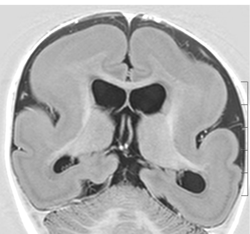 lissencephaly type 2