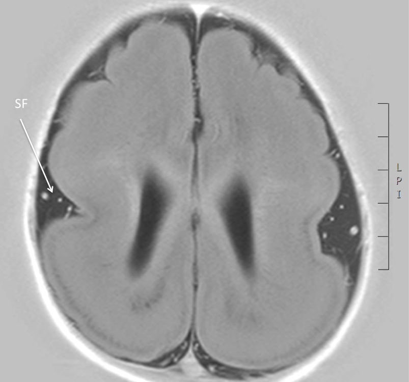 lissencephaly type 3