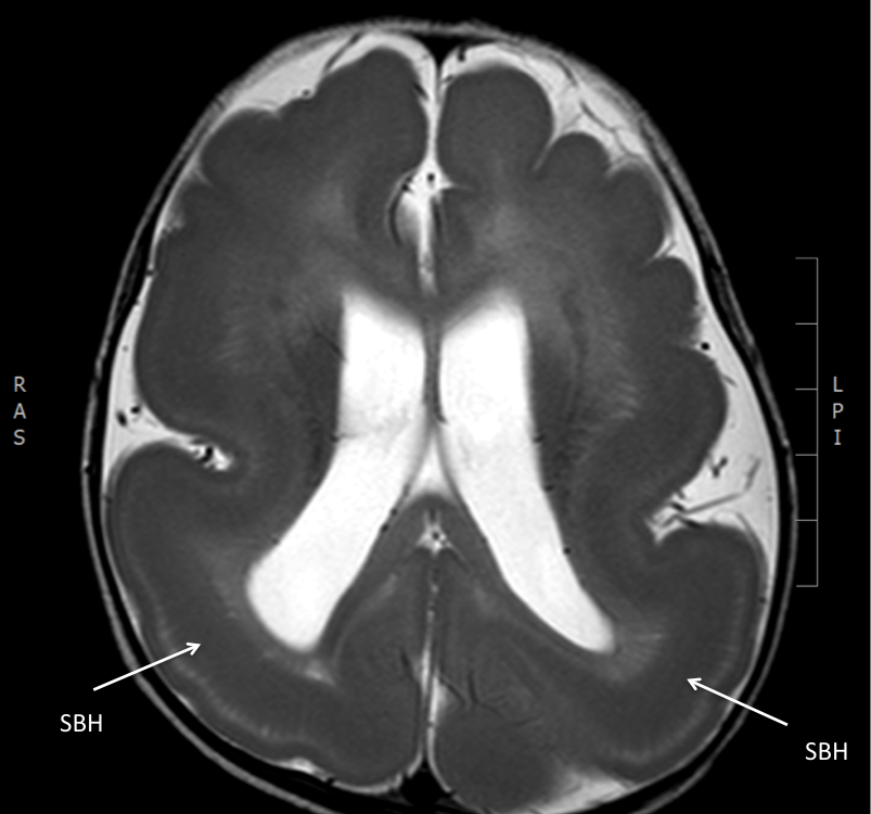 lissencephaly type 4