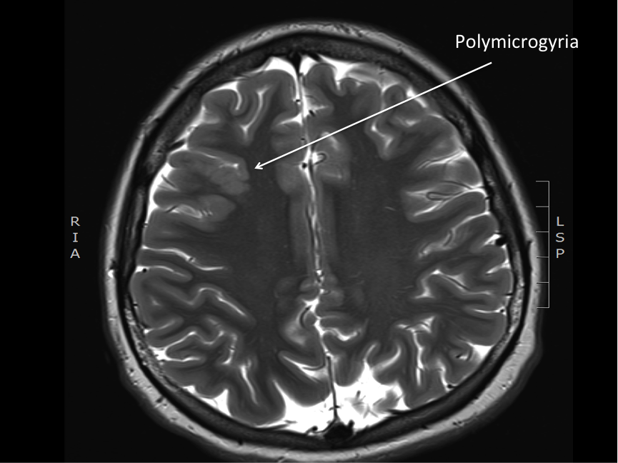 polymicrogyria 1