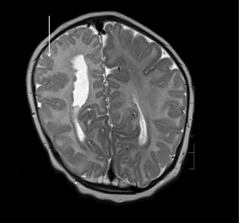 polymicrogyria 2