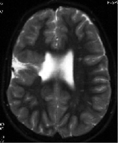 schizencephaly 1